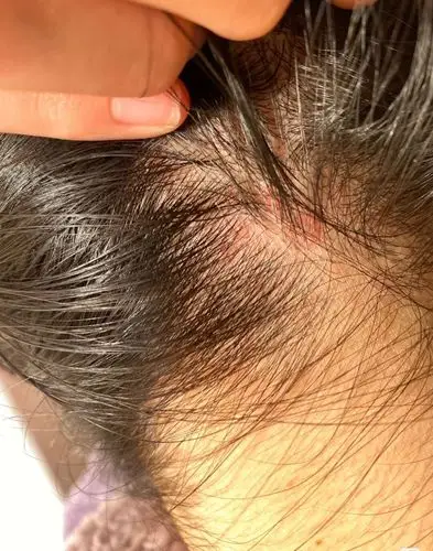 脂溢性皮炎头皮屑头痒治愈全经过