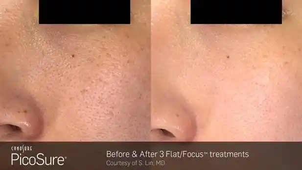 毛孔粗大治疗前后对比图