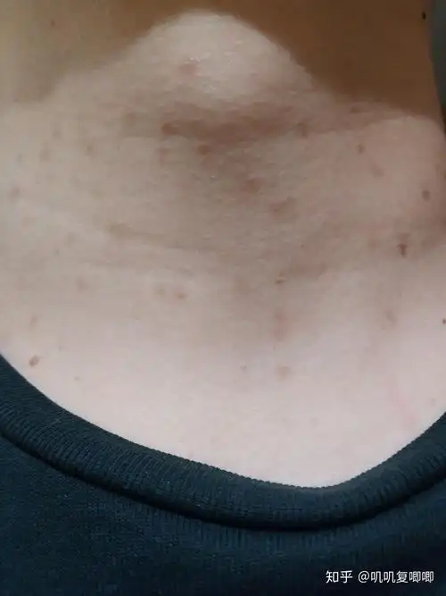 丝状疣,脖子上,女性,医生说要激光扫,有别的办法吗? - 知乎