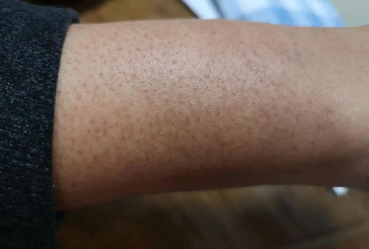 手臂上长"鸡皮疙瘩"是怎么回事?