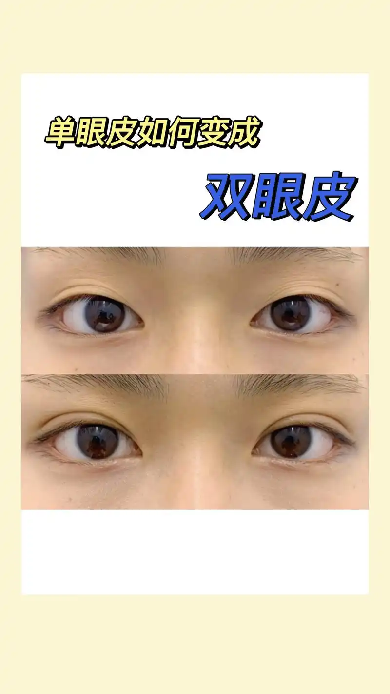 单眼皮变双眼皮的方法有哪些?#双眼皮蜕变记 #双眼皮 #一 - 抖音