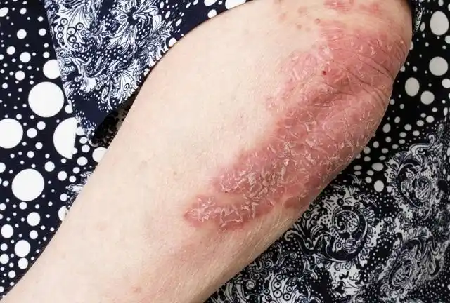 牛皮屑病早期症状图片大全_银屑病求医网