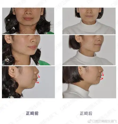 正畸前后面型对比