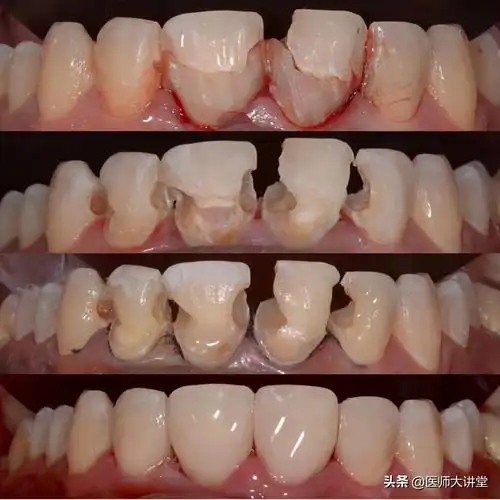 就会面对着蛀牙,牙疼,牙齿损伤,牙周病,牙齿不整齐,缺牙的各种病症
