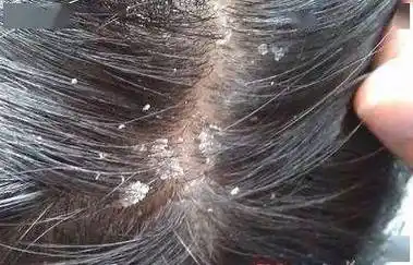 但当头皮异常病变时,如细菌感染,真菌感染,或其它物理,化学性伤害