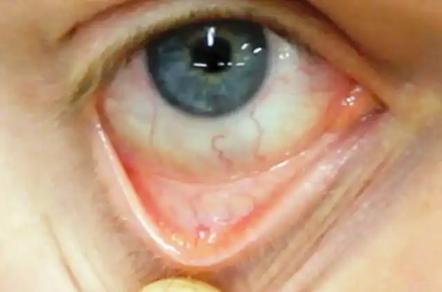 但是如果变得不那么红,甚至很白,往往说明肯能出现了贫血,如下图所示