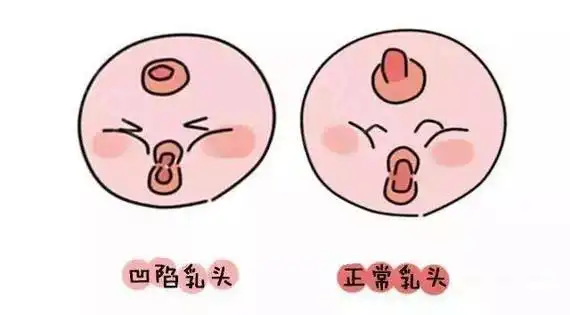 乳头内陷可别拽,拽也拽不出来!让我教你最好的办法!