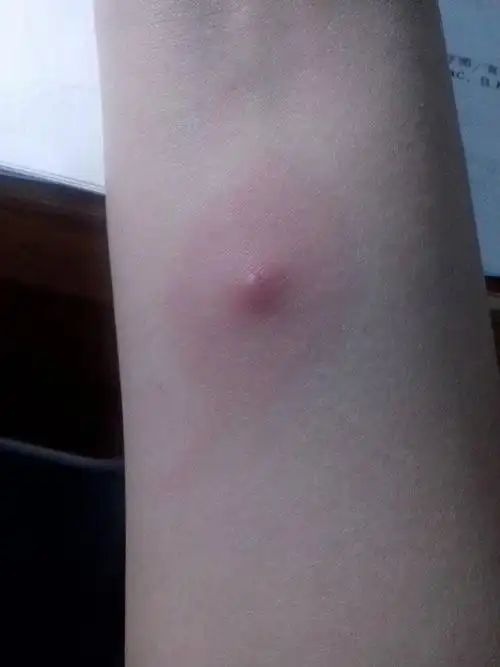 今天在手臂上看到这样一个包以为是蚊子咬的.挠了一下疼死了.