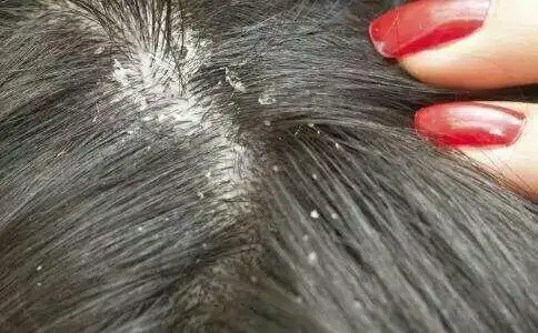 写美篇1 干性头皮 这就是我们经常说的 头皮干.