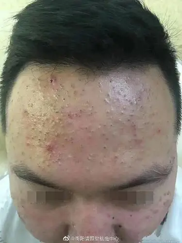 额头上长了很多黑头粉刺