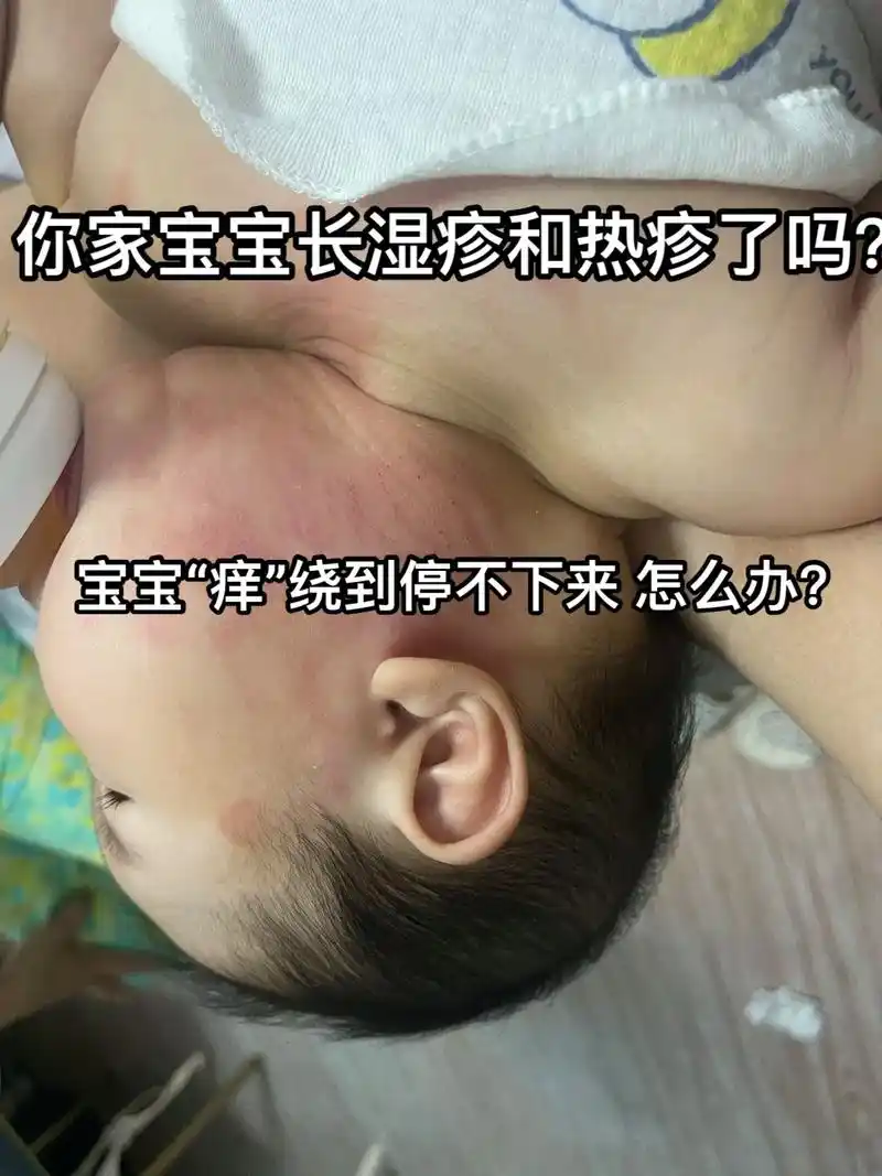 宝宝长热疹和湿疹怎么办?是过敏体质吗?五个月左右开始有湿疹  - 抖音