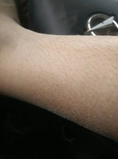 我的小腿皮肤这样.是不是太干燥了?还是缺什么?该吃什么?