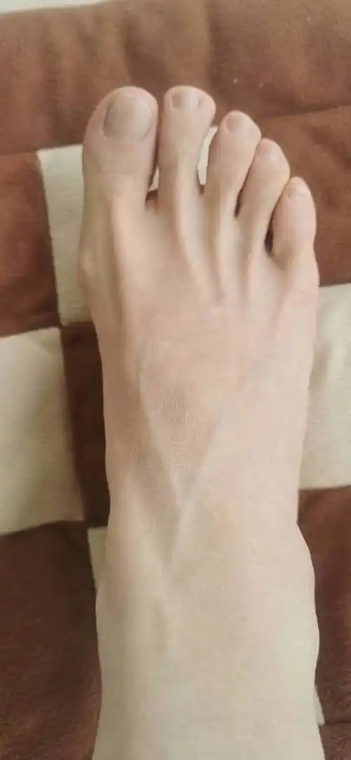 昨天突然发现手背脚背的静脉没有那么凸起,更没有那么粗了,肉眼看似乎