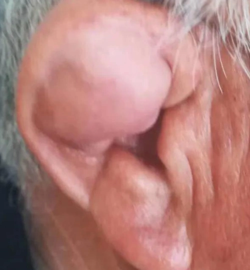 一个月后,王大爷发现耳朵上的小包不仅没有消失,还变得肿大了,有时候