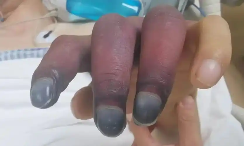 年轻小伙蹲着干活起身后出现大块淤斑手指坏死等待截肢