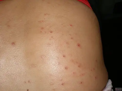 疥疮的可能性大吗?  [ 本帖最后由 快乐萤火虫