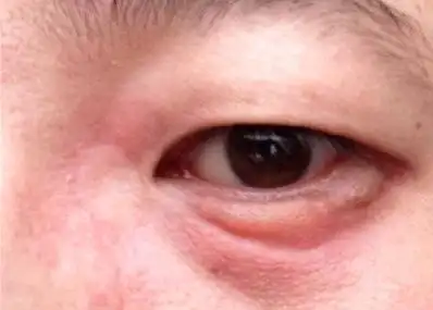 眼睛浮肿是什么原因