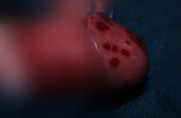 包皮炎初期图片 (35)_有来医生