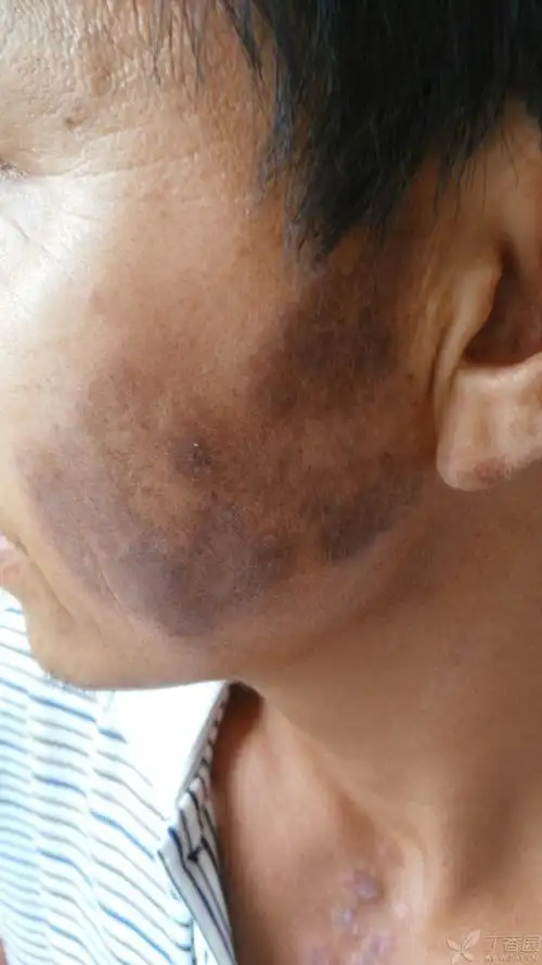 面部黑变病?求皮肤科大侠指导.