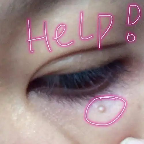 (有图慎入!)眼睛下面长了个硕大的脂肪粒怎么去掉啊!