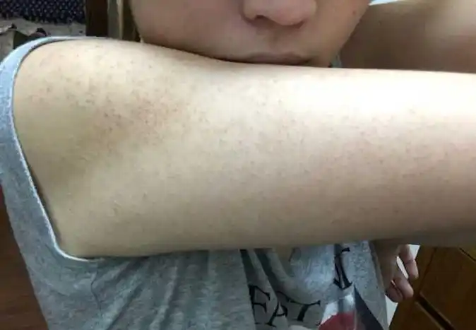 胳膊上的鸡皮肤怎么治 这些方法效果太好了_肌肤
