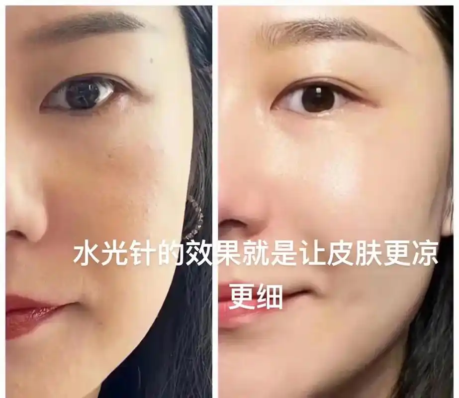 水光针的作用,让皮肤更光滑细腻更水嫩 - 抖音