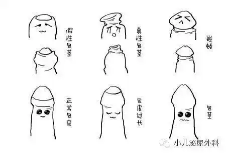 科普一下什么是儿童的包皮过长,包茎_包皮过长_介绍_治疗方式