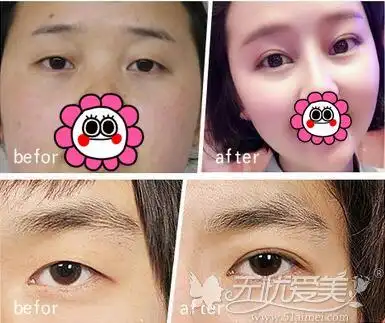 埋线双眼皮前后对比案例