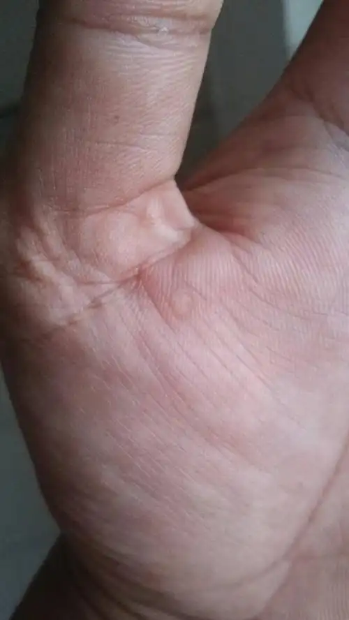 区张格庄医院 答: 你说的情况不是痣的,考虑是皮肤角化引起的症状的