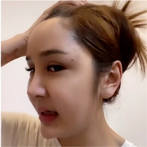 女网红整容失败出现严重后遗症,脸肿成馒头眼睛睁不开,崩溃痛哭称自己