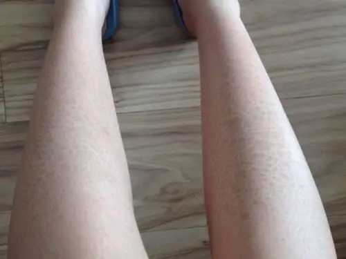 冬季皮肤干燥起皮怎么办