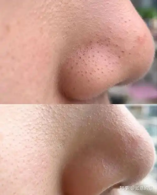 为什么医学生强烈建议你黑头去不干净反反复复的时候,直接用刷酸 泥膜