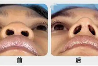 科普鼻孔缩小手术方法特点适应人群