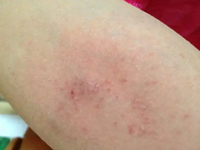 胳肢窝 大腿根胳膊肘 都是这个红疙瘩 奇痒 这两天肩膀上满 快长满