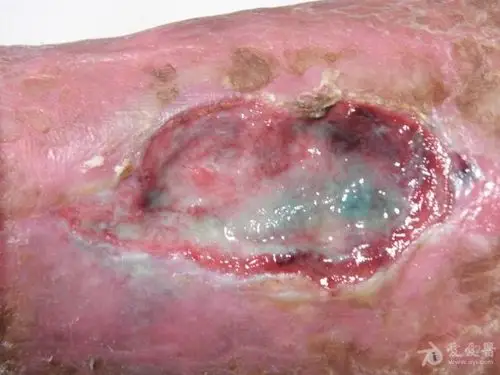 骨折后下肢溃疡