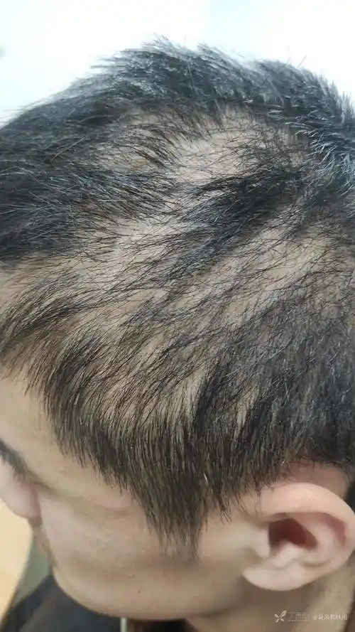 图片分享拔毛癖一例