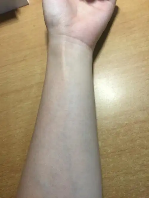 想问下大家这种手臂突然泛起的不痛不痒的点点是什么