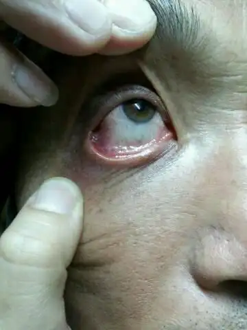 下眼睑肿,里面有块小红肿,很很难