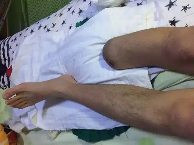 励志留学生因意外被截肢失去小腿但却活出硬核人生