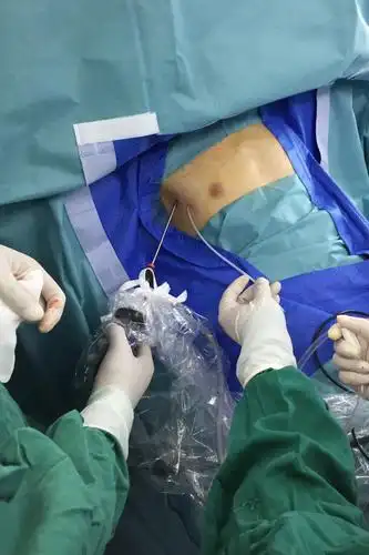 深圳胸外科日间手术来了,病人24小时内出院