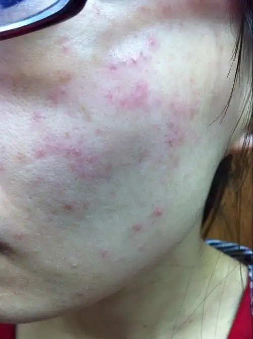 中医 过敏 长小疹子