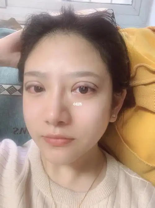 双眼皮手术当天