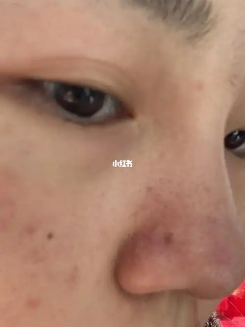 鼻子上黑黑的是黑头吗?怎么去不掉?