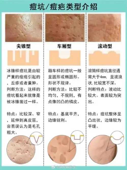 痘痘,痘印,痘坑,痘疤修复##祛痘坑痘印##全国医美科普日