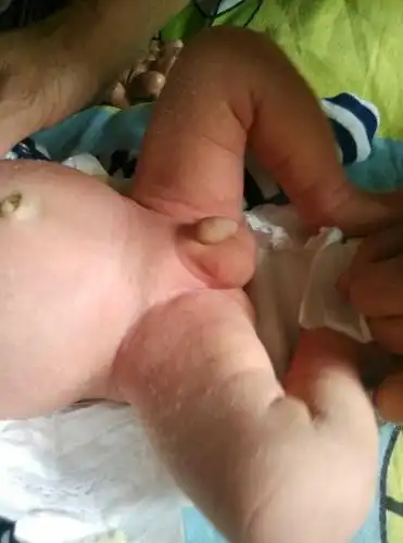 [2014年8月妈妈帮]宝宝脱皮