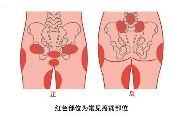 耻骨痛到底是哪里痛?孕期有四类孕妇容易被它"找上门"