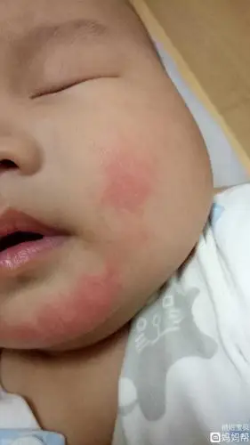 宝贝脸蛋一开始是下巴红,不知道是不是口水湿的原因,然后脸也红了