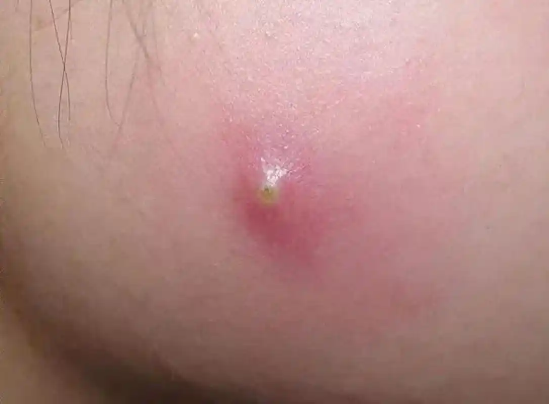 脸上长了个毛囊炎,挤了挤,脓没挤出来,结果变大了,变成疖了.