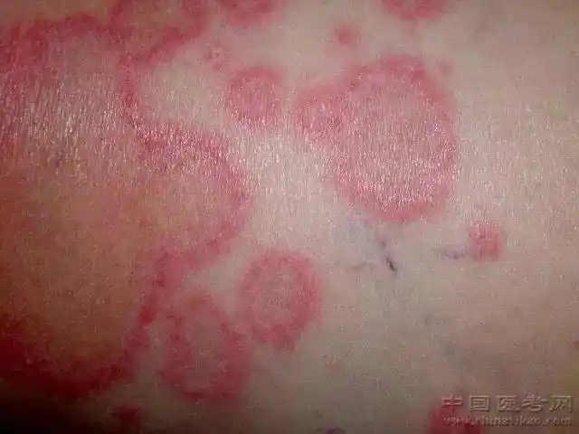 超珍贵皮肤病图谱!还剩99张,都给你了