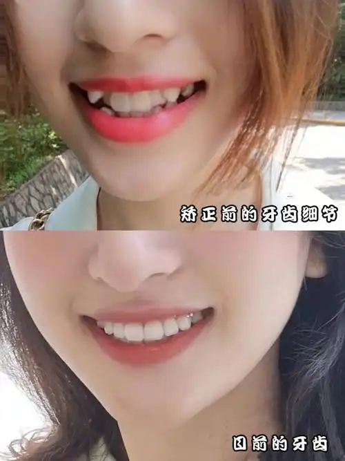 虎牙小姐姐说没有虎牙后太轻松了9997矫正机构:拜博口_圈子-新氧